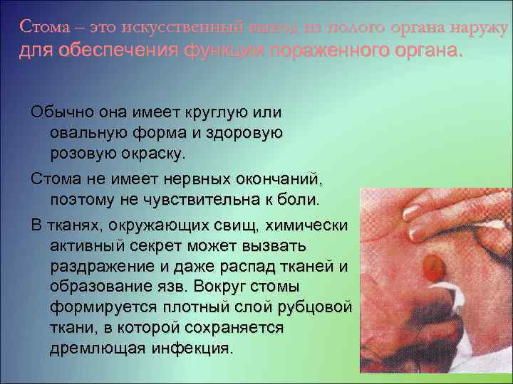 Стома – это искусственный выход из полого органа наружу для обеспечения функции пораженного органа.