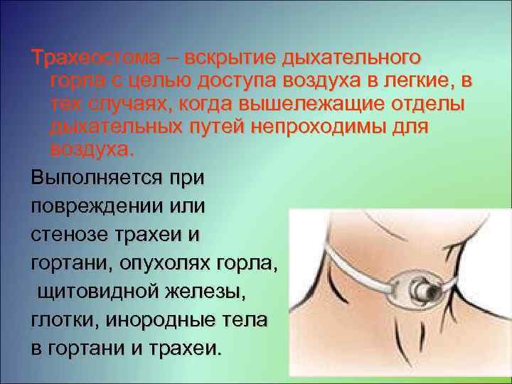 Трахеостома – вскрытие дыхательного горла с целью доступа воздуха в легкие, в тех случаях,