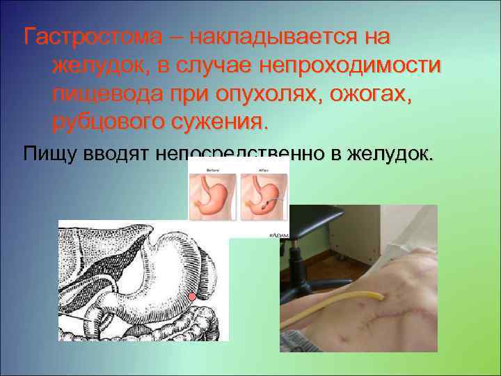 Гастростома – накладывается на желудок, в случае непроходимости пищевода при опухолях, ожогах, рубцового сужения.