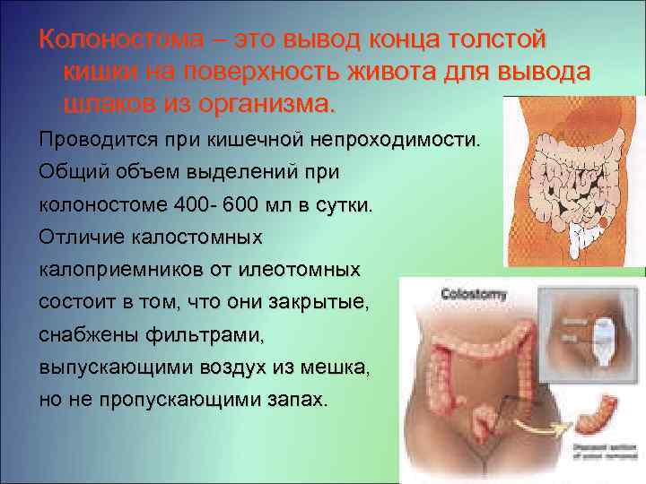 Колоностома – это вывод конца толстой кишки на поверхность живота для вывода шлаков из