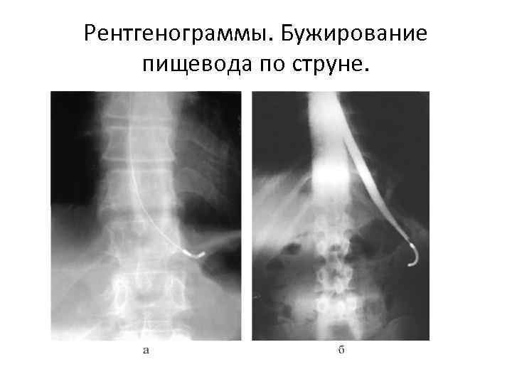 Рентгенограммы. Бужирование пищевода по струне. 