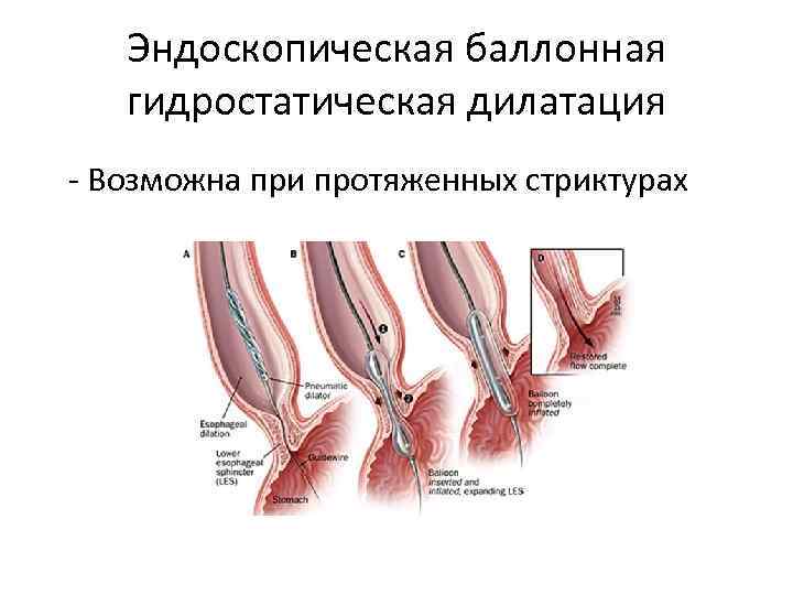 Эндоскопическая баллонная гидростатическая дилатация - Возможна при протяженных стриктурах 