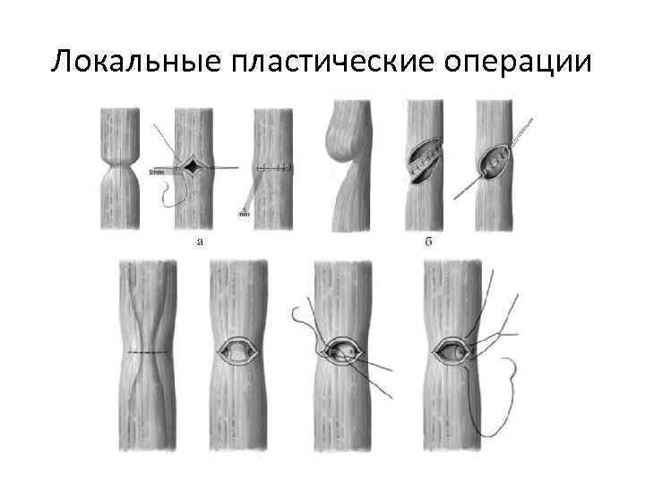 Локальные пластические операции 