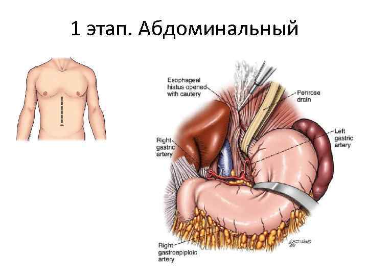 1 этап. Абдоминальный 