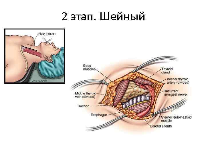 2 этап. Шейный 