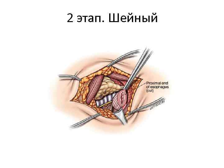 2 этап. Шейный 