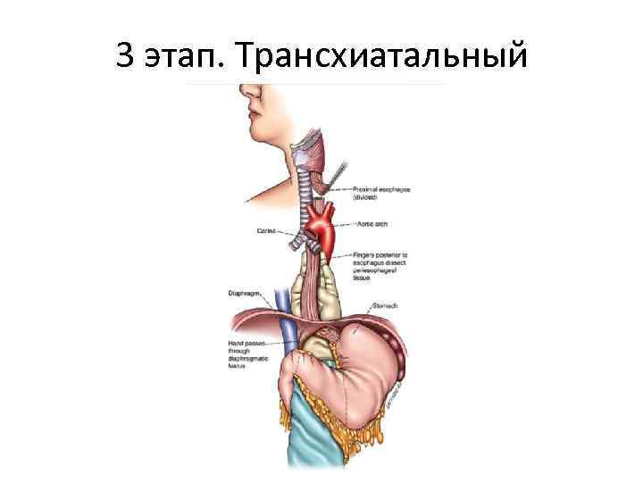 3 этап. Трансхиатальный 