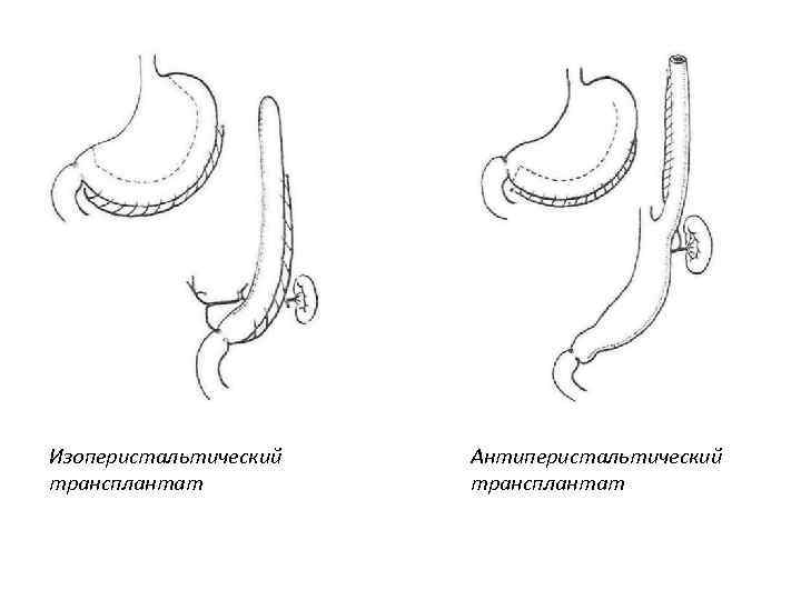 Изоперистальтический трансплантат Антиперистальтический трансплантат 