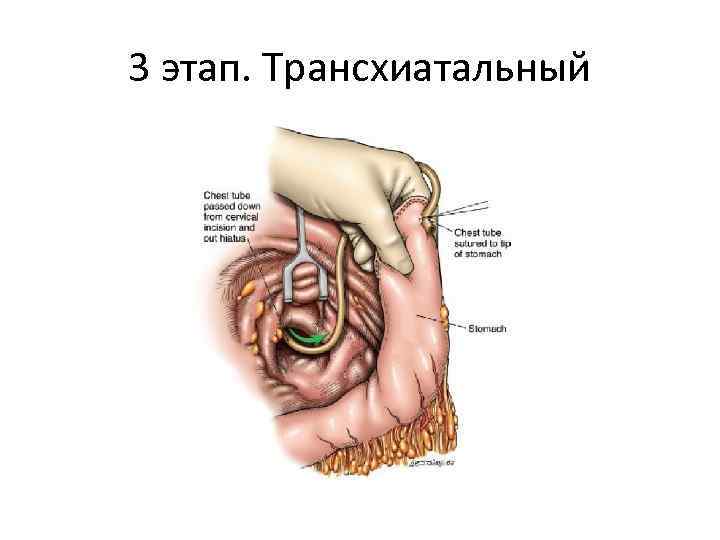 3 этап. Трансхиатальный 