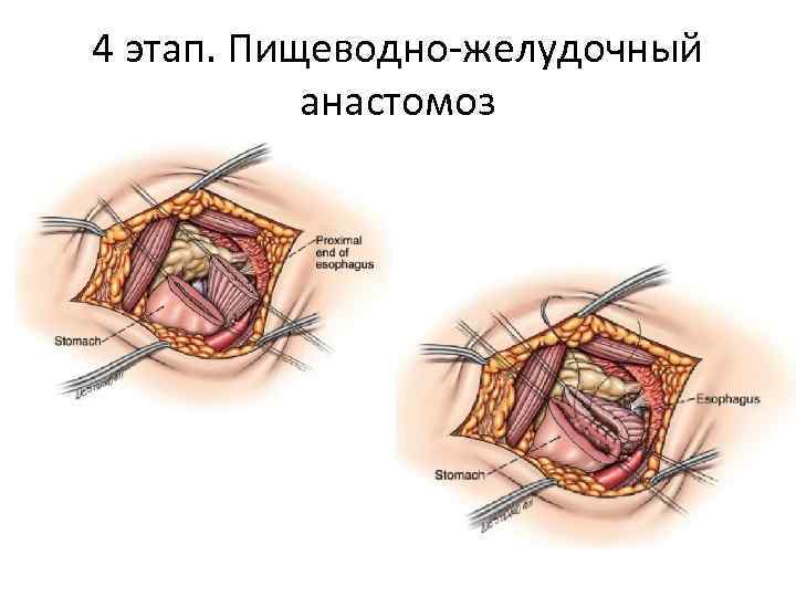 4 этап. Пищеводно-желудочный анастомоз 