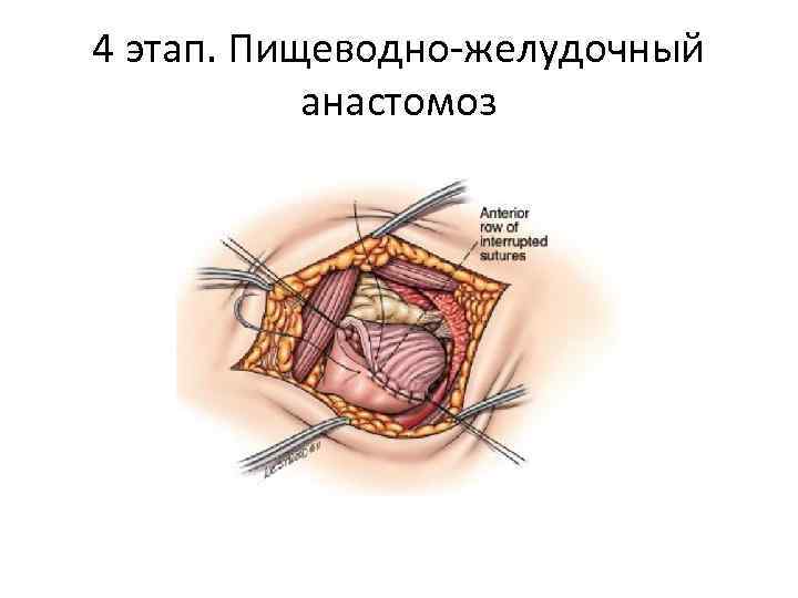 4 этап. Пищеводно-желудочный анастомоз 