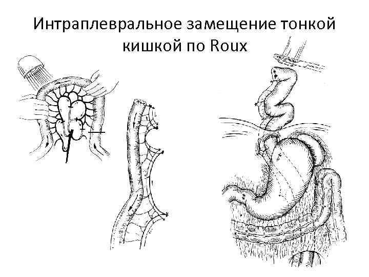 Интраплевральное замещение тонкой кишкой по Roux 