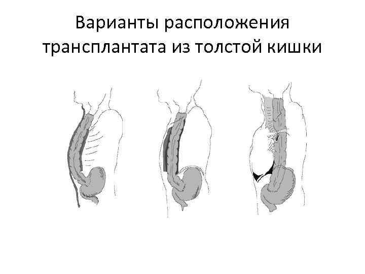 Варианты расположения трансплантата из толстой кишки 