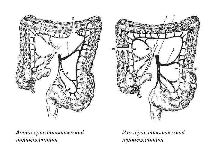 Антиперистальтический трансплантат Изоперистальтический трансплантат 