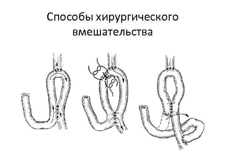 Способы хирургического вмешательства 