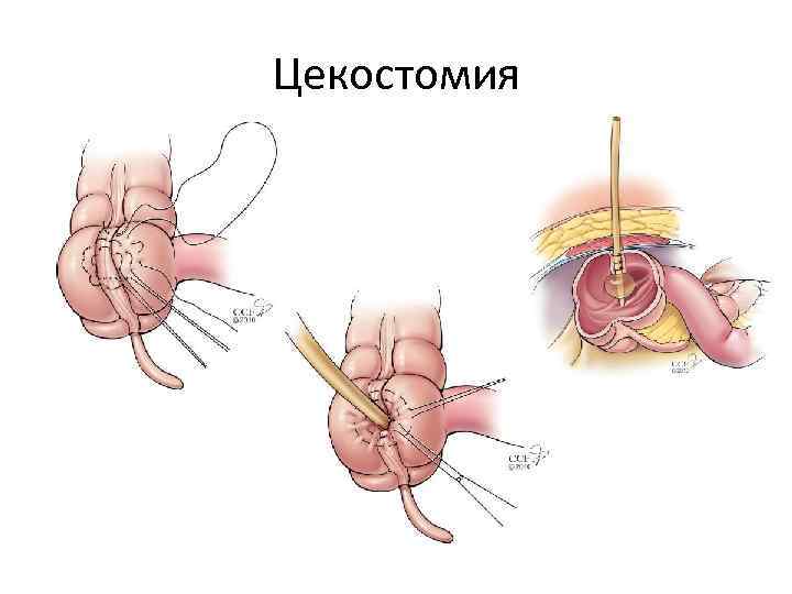Цекостомия 