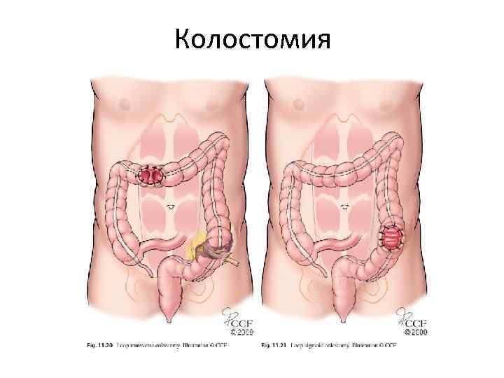 Колостомия 