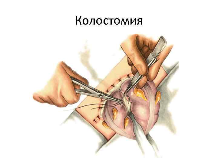 Колостомия 