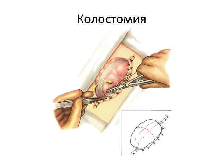 Колостомия 