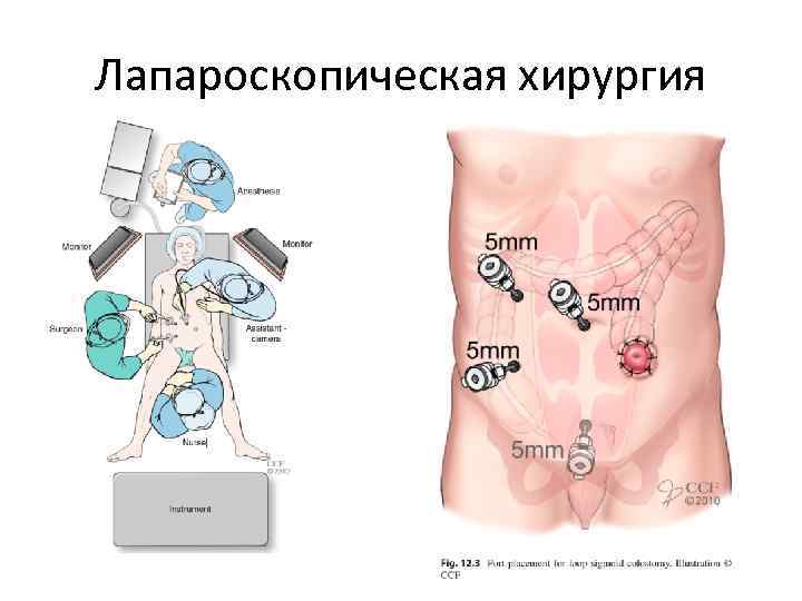 Лапароскопическая хирургия 