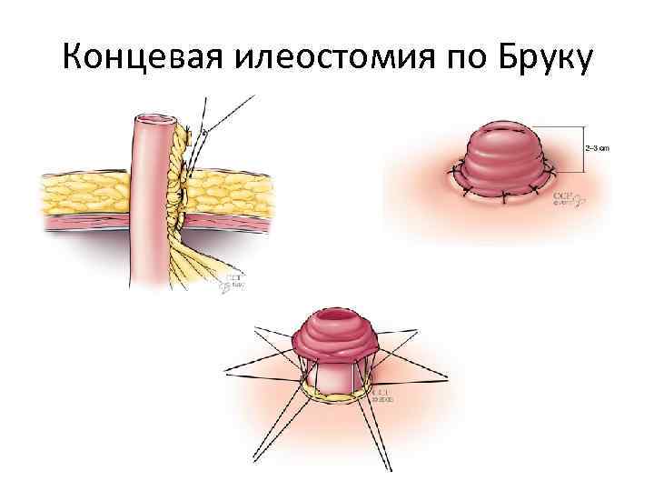 Концевая илеостомия по Бруку 