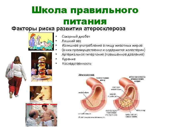 Школа правильного питания Факторы риска развития атеросклероза • • Сахарный диабет Лишний вес Излишнее