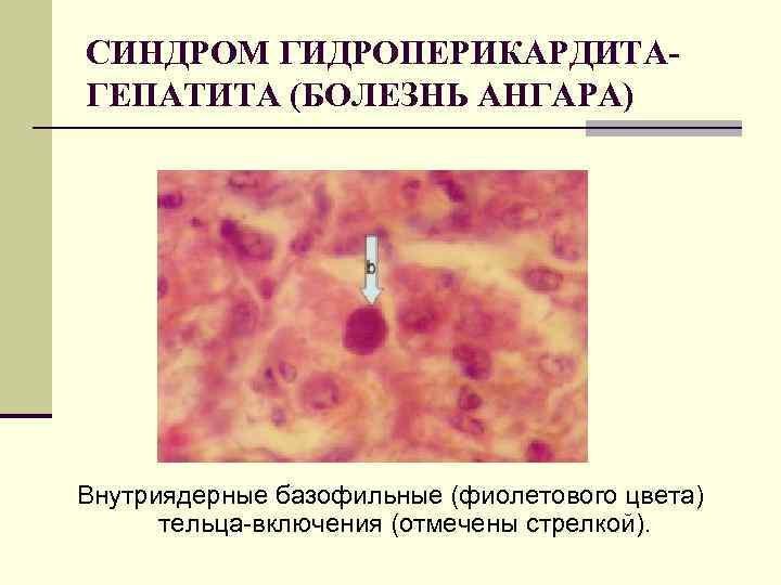 СИНДРОМ ГИДРОПЕРИКАРДИТАГЕПАТИТА (БОЛЕЗНЬ АНГАРА) Внутриядерные базофильные (фиолетового цвета) тельца-включения (отмечены стрелкой). 