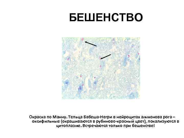 БЕШЕНСТВО Окраска по Манну. Тельца Бабеша Негри в нейроцитах аммонова рога – оксифильные (окрашиваются
