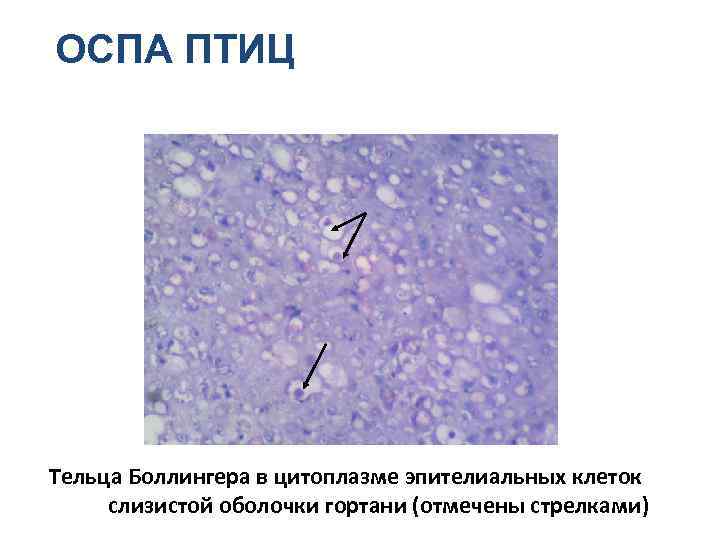 ОСПА ПТИЦ Тельца Боллингера в цитоплазме эпителиальных клеток слизистой оболочки гортани (отмечены стрелками) 
