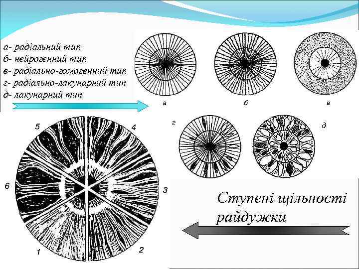 а- радіальний тип б- нейрогенний тип в- радіально-гомогенний тип г- радіально-лакунарний тип д- лакунарний