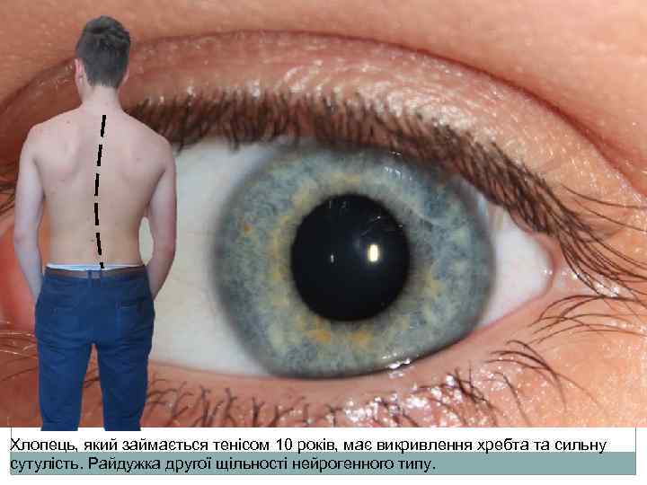Хлопець, який займається тенісом 10 років, має викривлення хребта та сильну сутулість. Райдужка другої