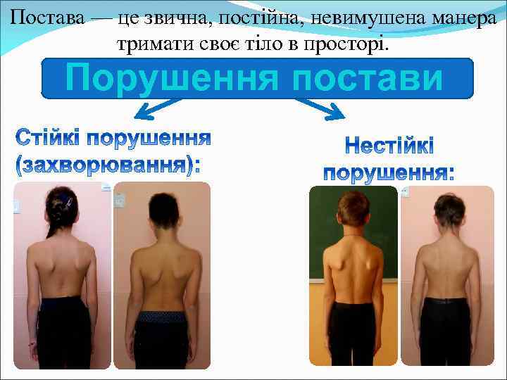 Постава — це звична, постійна, невимушена манера тримати своє тіло в просторі. Порушення постави