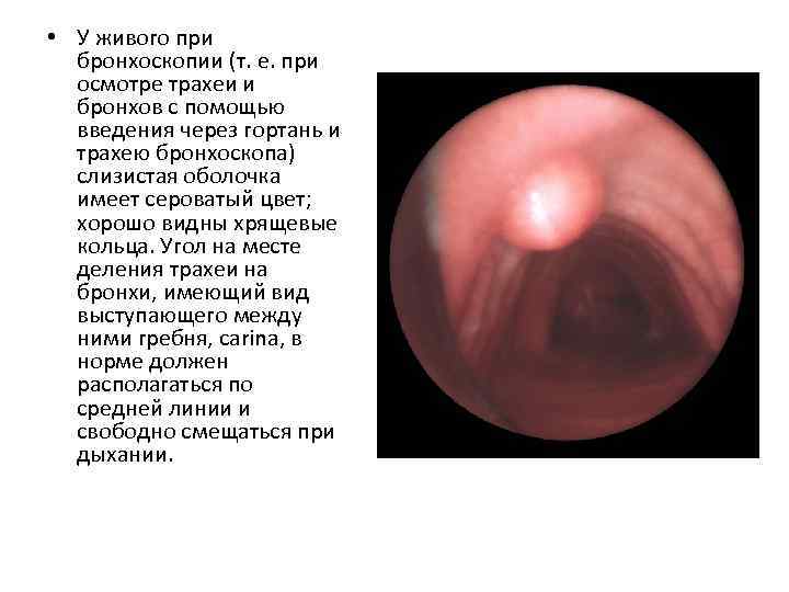  • У живого при бронхоскопии (т. е. при осмотре трахеи и бронхов с