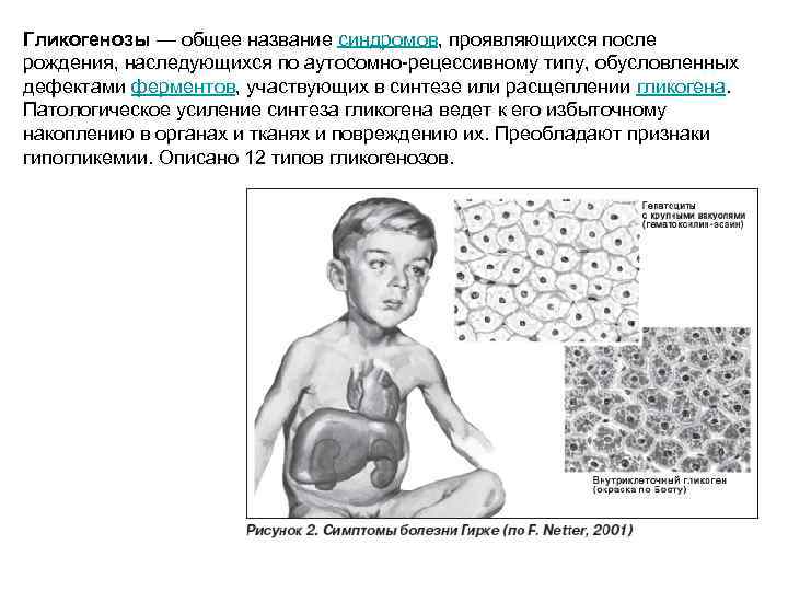 Гликогенозы — общее название синдромов, проявляющихся после рождения, наследующихся по аутосомно-рецессивному типу, обусловленных дефектами