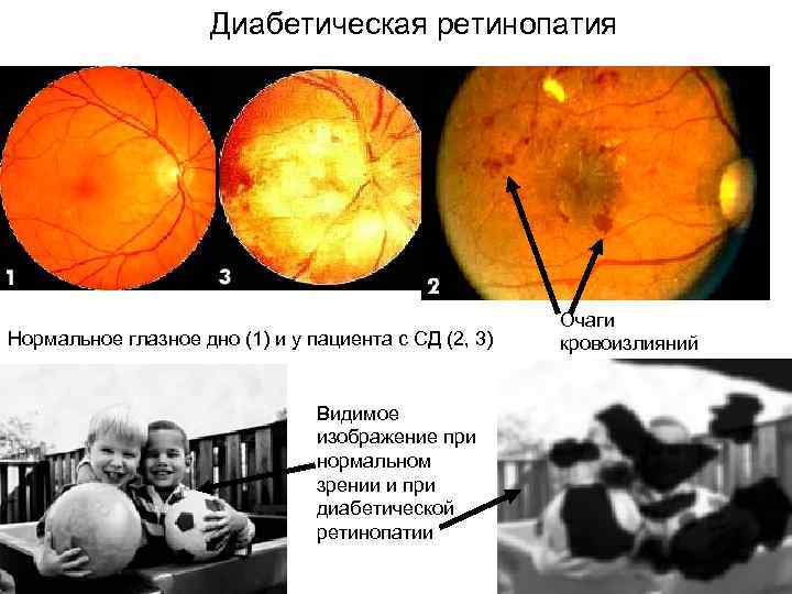 Изменение глазного дна при сахарном диабете презентация