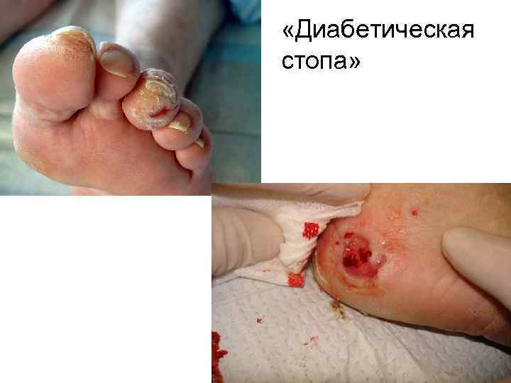  «Диабетическая стопа» 