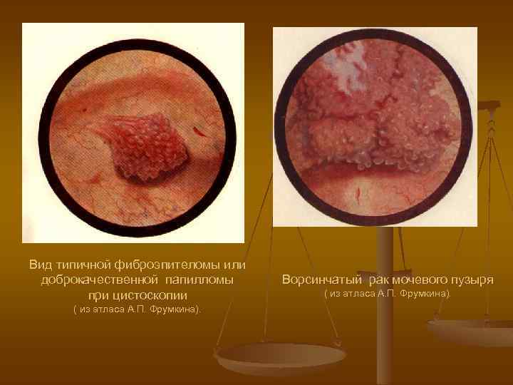 Вид типичной фиброэпителомы или доброкачественной папилломы при цистоскопии ( из атласа А. П. Фрумкина).