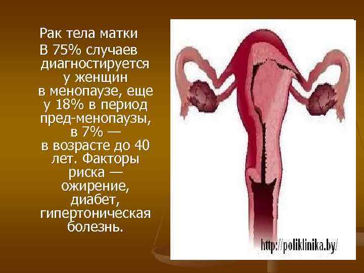 Рак тела матки В 75% случаев диагностируется у женщин в менопаузе, еще у 18%