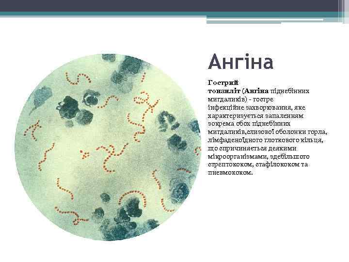 Ангіна Гострий тонзиліт (Ангіна піднебінних мигдаликів) - гостре інфекційне захворювання, яке характеризується запаленням зокрема