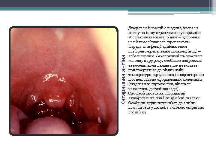 Катаральна ангіна Джерелом інфекції є людина, хвора на ангіну чи іншу стрептококову інфекцію або