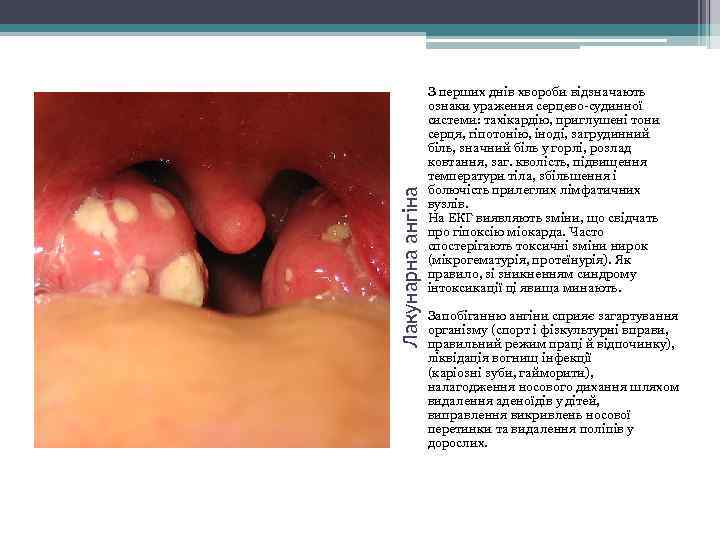 Лакунарна ангіна З перших днів хвороби відзначають ознаки ураження серцево-судинної системи: тахікардію, приглушені тони