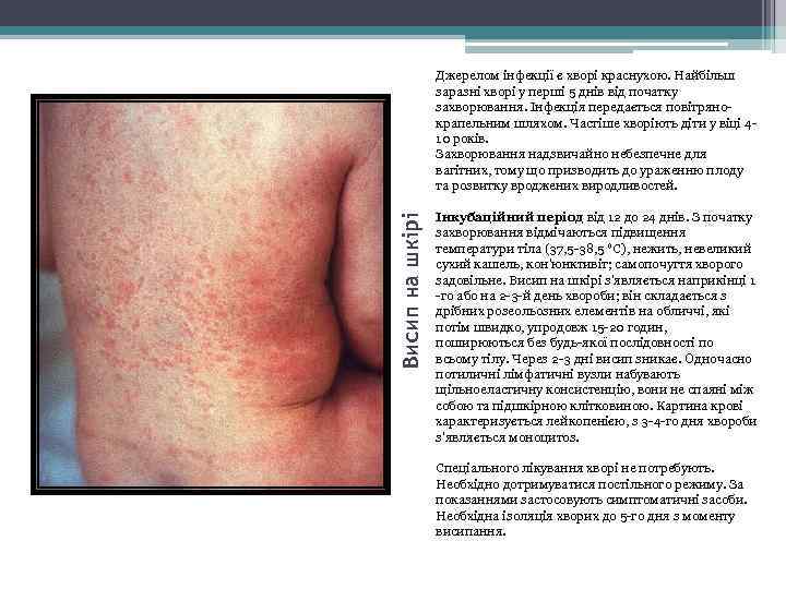 Висип на шкірі Джерелом інфекції є хворі краснухою. Найбільш заразні хворі у перші 5
