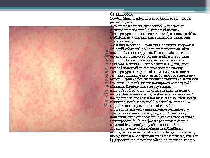 Як кір уражає шкіру Симптоми Інкубаційний період при кору складає від 7 до 21,