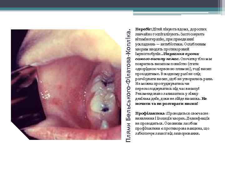 Плями Бельського-Філатова-Копліка. Перебіг: Дітей лікують вдома, дорослих звичайно госпіталізують. Застосовують вітамінотерапію, приєднанні ускладнень —