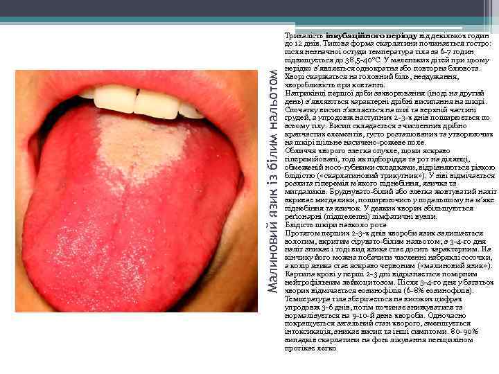 Малиновий язик із білим нальотом Тривалість інкубаційного періоду від декількох годин до 12 днів.