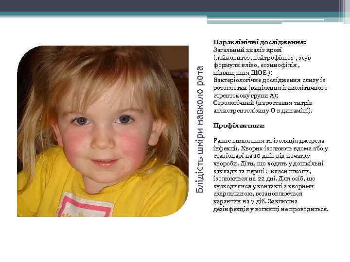 Блідість шкіри навколо рота Параклінічні дослідження: Загальний аналіз крові (лейкоцитоз, нейтрофільоз , зсув формули