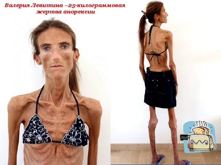 Валерия Левитина – 25 -килограммовая жертва анорексии 