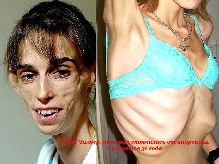 Cetosis anorexia