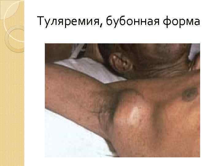 Туляремия, бубонная форма 