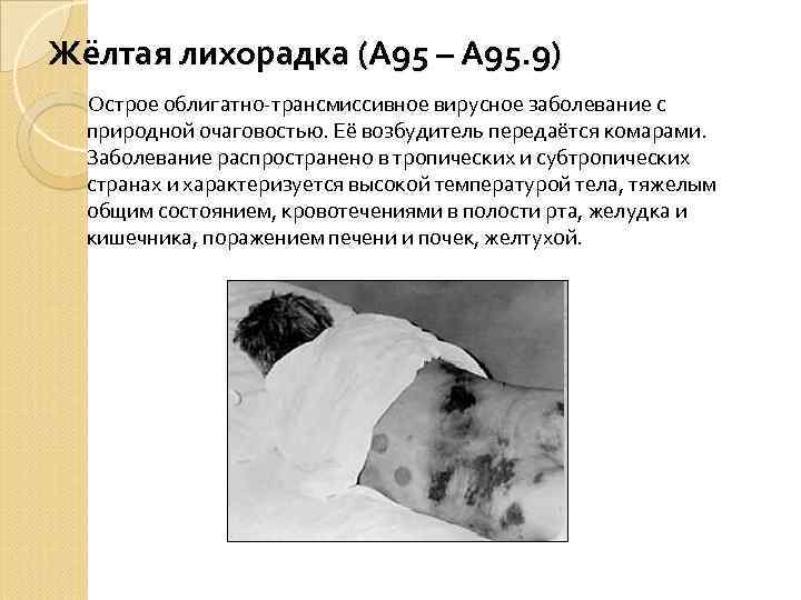 Жёлтая лихорадка (А 95 – А 95. 9) Острое облигатно-трансмиссивное вирусное заболевание с природной